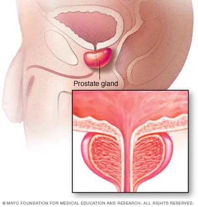 Men's Health: Chronic Non-Bacterial Prostatitis aka CPPS
